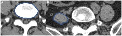 Analysis of CT imaging changes of psoas major muscles in patients with lumbar disc herniation mainly based on low back pain and lower limb pain